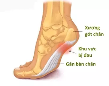 Đau âm ỉ phần gót chân và vòm bàn chân cảnh báo bệnh lý viêm cân gan bàn chân